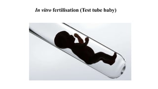In vitro fertilisation (Test tube baby)
 