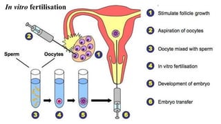 In vitro fertilisation
 