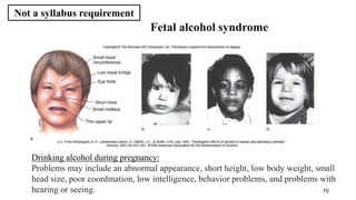 70
Fetal alcohol syndrome
Drinking alcohol during pregnancy:
Problems may include an abnormal appearance, short height, low body weight, small
head size, poor coordination, low intelligence, behavior problems, and problems with
hearing or seeing.
Not a syllabus requirement
 