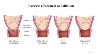 Cervical effacement and dilation
80
 