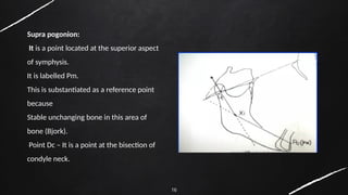 16
Supra pogonion:
It is a point located at the superior aspect
of symphysis.
It is labelled Pm.
This is substantiated as a reference point
because
Stable unchanging bone in this area of
bone (Bjork).
Point Dc – It is a point at the bisection of
condyle neck.
 