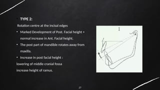 27
• TYPE 2:
Rotation centre at the incisal edges
• Marked Development of Post. Facial height +
normal increase in Ant. Facial height.
• The post part of mandible rotates away from
maxilla.
• Increase in post facial height :
lowering of middle cranial fossa
increase height of ramus.
 