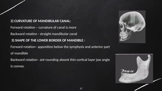 37
2) CURVATURE OF MANDIBULAR CANAL:
Forward rotation – curvature of canal is more
Backward rotation - straight mandibular canal
3) SHAPE OF THE LOWER BORDER OF MANDIBLE :
Forward rotation– apposition below the symphysis and anterior part
of mandible
Backward rotation– ant rounding absent thin cortical layer jaw angle
is convex.
 