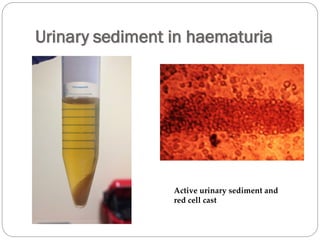 Urinary sediment in haematuria
Active urinary sediment and
red cell cast
 