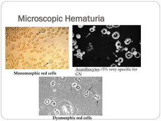 Microscopic Hematuria
Monomorphic red cells
Dysmorphic red cells
Acanthocytes >5% very specific for
GN
 