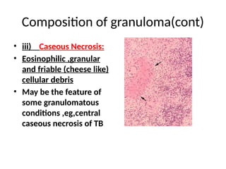 Caseation Cheese Comprehensive Overview of Chronic Caseating Granulomatous Inflammation ...