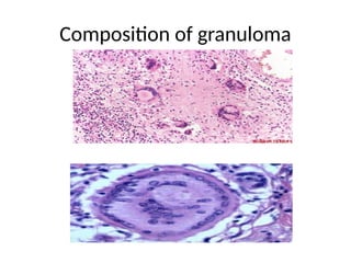 Caseating Definition Comprehensive Overview of Chronic Caseating Granulomatous Inflammation ...