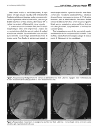 255Arterite de Takayasu − Conhecer para diagnosticar
Borelli FAO, Gonzaga C, Lotaif L, Cordeiro A, Sousa MG, Passarelli Jr. O, Amodeo C
Rev Bras Hipertens vol.16(4):254-257, 2009.
Nesta mesma ocasião, foi constatada a presença de sopro
sistólico em região cervical esquerda, sendo então solicitado
Doppler de carótidas e vertebrais que revelou espessamento im-
portantedaparededasartériascarótidascomuns,comobstrução
de 50% das artérias carótidas externas, obstrução de 15% na
carótida interna direita e 50% na carótida interna esquerda.
A paciente evoluiu com controle dos níveis pressóricos após
angioplastia para artéria renal comprometida e recebeu alta
em uso de ácido acetilsalicílico, atenolol, maleato de enalapril
e besilato de anlodipino. Aproximadamente dois anos após
o procedimento, houve elevação persistente dos níveis de
pressão arterial. Novo Doppler de artérias renais realizado na
ocasião sugeriu estenose significativa da artéria renal direita.
A arteriografia realizada na ocasião confirmou o achado do
ultrassom Doppler, mostrando uma estenose de 70% da artéria
renal direita, além de oclusão da artéria ilíaca externa direita e
estenose de 60% da artéria ilíaca comum esquerda (Figura 1).
Optado por nova angioplastia na artéria renal direita, desta vez
com colocação de stent, cujo procedimento foi realizado com
sucesso (Figura 2).
A paciente evoluiu com controle dos seus níveis de pressão
arterial e recebeu alta em uso apenas de hidroclorotiazida 25 mg/
dia. Nesta ocasião, foi encaminhada para avaliação de possível
arterite de Takayasu em serviço especializado.
Figura 1. À esquerda angiografia digital mostrando estenose de 70% na artéria renal direita e, à direita, angiografia digital mostrando oclusão
de artéria ilíaca externa direita e 60% de oclusão na artéria Ilíaca comum esquerda.
Figura 2. À esquerda lesão importante em um terço proximal de artéria renal direita e, à direita, a mesma situação anterior, porém sem a lesão
estenótica após implante de stent neste vaso.
 