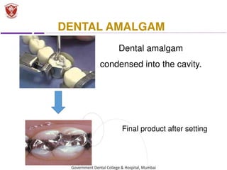 Dental-Amalgam introduction and types.pdf
