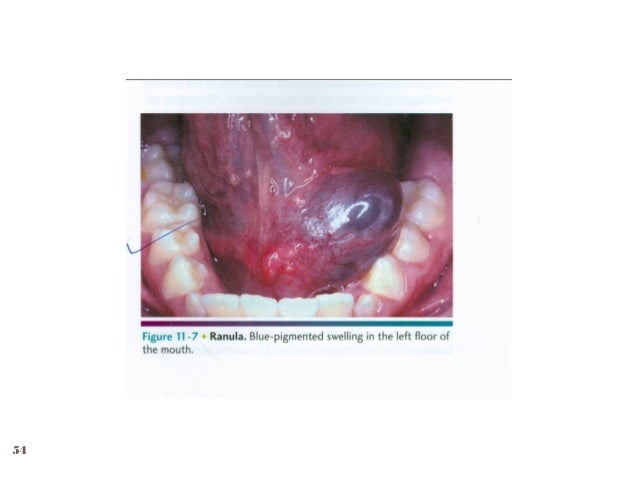 16 diseases of salivary glands
