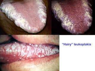 “Hairy” leukoplakia 
 