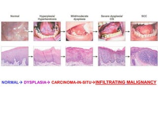 NORMAL DYSPLASIA CARCINOMA-IN-SITUINFILTRATING MALIGNANCY 
 