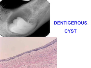 DENTIGEROUS 
CYST 
 