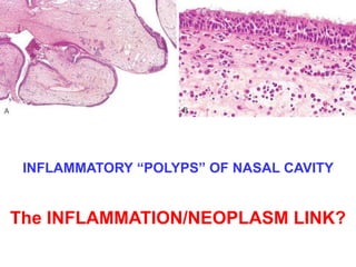 INFLAMMATORY “POLYPS” OF NASAL CAVITY 
The INFLAMMATION/NEOPLASM LINK? 
 