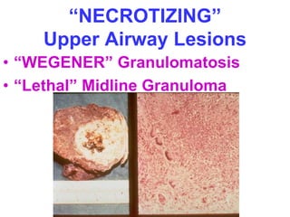 “NECROTIZING” 
Upper Airway Lesions 
• “WEGENER” Granulomatosis 
• “Lethal” Midline Granuloma 
 