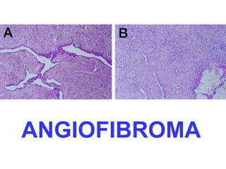 ANGIOFIBROMA 
 