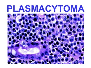 PLASMACYTOMA 
 