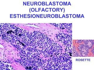 NEUROBLASTOMA 
(OLFACTORY) 
ESTHESIONEUROBLASTOMA 
ROSETTE 
 