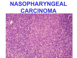 NASOPHARYNGEAL 
CARCINOMA 
 
