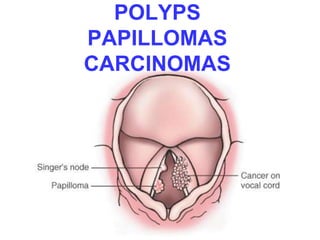 POLYPS 
PAPILLOMAS 
CARCINOMAS 
 