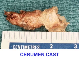CERUMEN CAST 
 