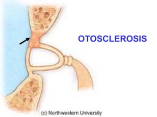 OTOSCLEROSIS 
 