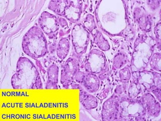 NORMAL 
ACUTE SIALADENITIS 
CHRONIC SIALADENITIS 
 