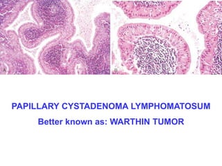 PAPILLARY CYSTADENOMA LYMPHOMATOSUM 
Better known as: WARTHIN TUMOR 
 