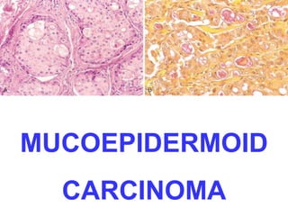 MUCOEPIDERMOID 
CARCINOMA 
 