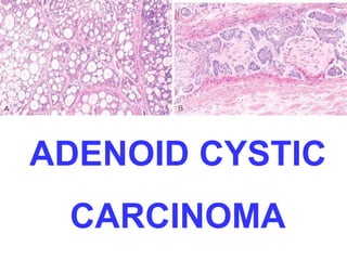 ADENOID CYSTIC 
CARCINOMA 
