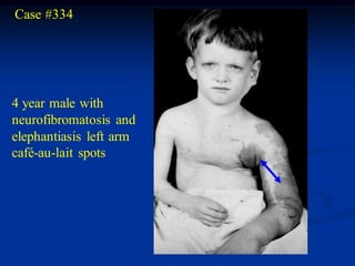 Case #334




4 year male with
neurofibromatosis and
elephantiasis left arm
café-au-lait spots
 