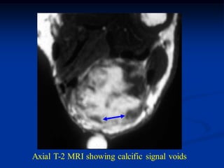 Axial T-2 MRI showing calcific signal voids
 