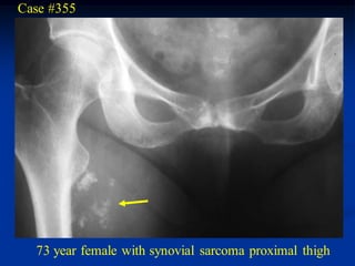 Case #355




  73 year female with synovial sarcoma proximal thigh
 