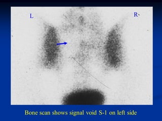 L                                       R




Bone scan shows signal void S-1 on left side
 