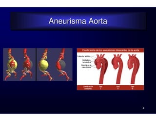 Aneurisma Aorta
Aneurisma Aorta
4