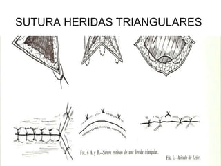 SUTURA HERIDAS TRIANGULARES 