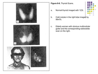 Figure 6-6. Thyroid Scans.
a. Normal thyroid imaged with 123I.
b. Cold nodule in the right lobe imaged by
99mTc.
c. Elderly woman with obvious multinodular
goiter and the corresponding radioiodide
scan on the right.
 