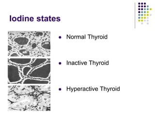 Iodine states
 Normal Thyroid
 Inactive Thyroid
 Hyperactive Thyroid
 
