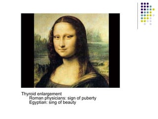 Thyroid enlargement
Roman physicians: sign of puberty
Egyptian: sing of beauty
 