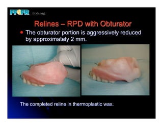 Relining In Rpd 16. (new)maxillary obturators trouble shooting, relines and other ...