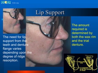 16.occlusal schemes lingualized occlusion | PPT