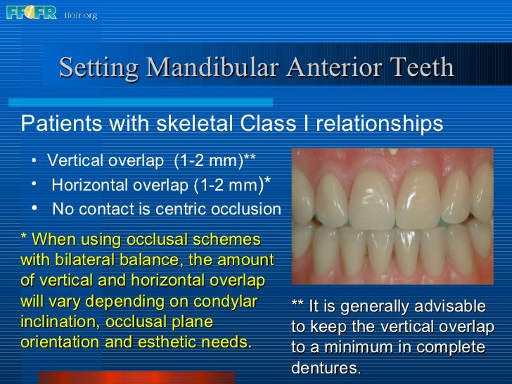 16.occlusal schemes lingualized occlusion