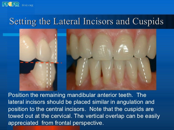 teeth setting