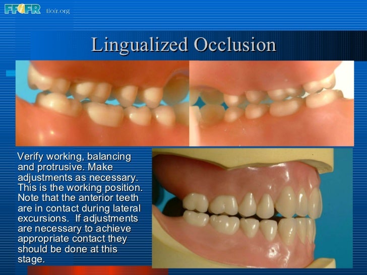 16.occlusal schemes lingualized occlusion