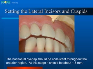 16.occlusal schemes lingualized occlusion | PPT