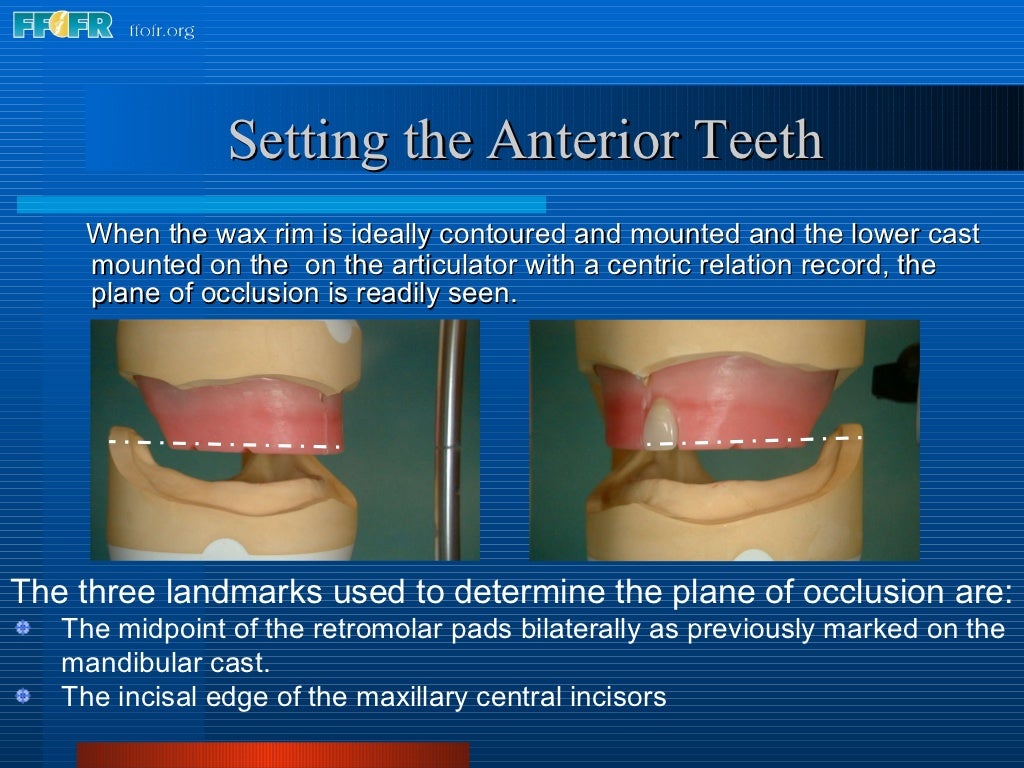 16.occlusal schemes lingualized occlusion