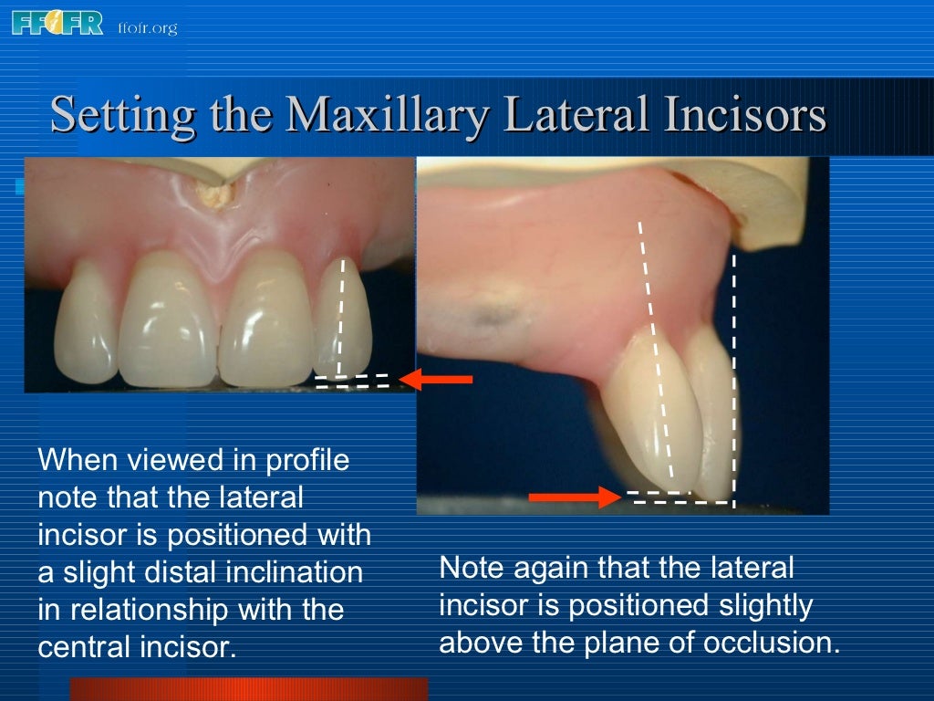 16.occlusal schemes lingualized occlusion