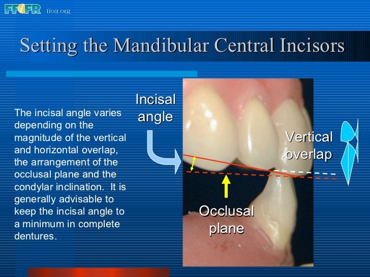 16.occlusal schemes lingualized occlusion