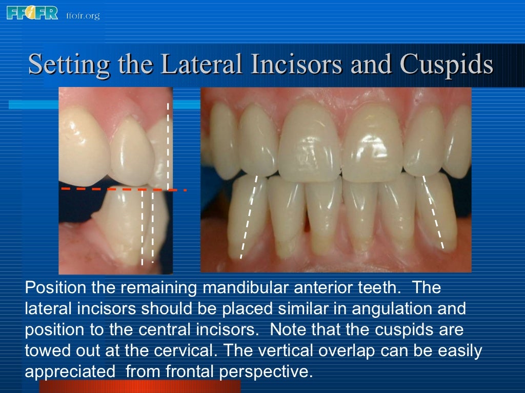 16.occlusal schemes lingualized occlusion
