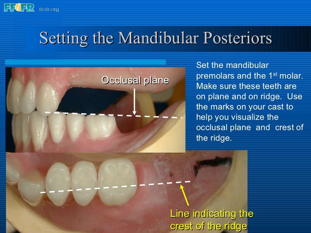 16.occlusal schemes lingualized occlusion
